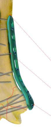 Дистальна медіальна плечова пластина ліва ( Double Medical Technology Inc.)